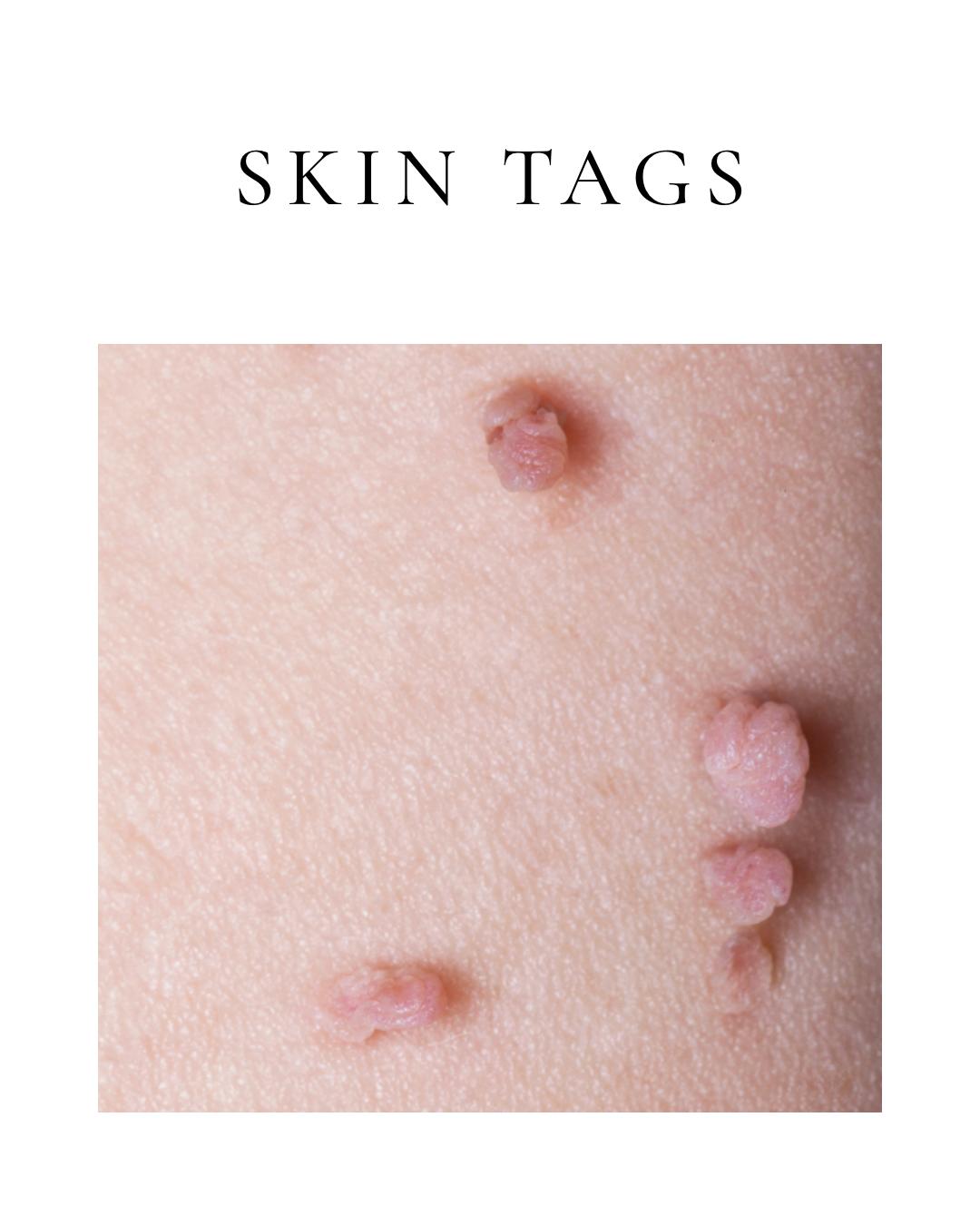 Skin Tags